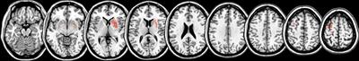 Predicting Training Gain for a 3 Week Period of Arm Ability Training in the Subacute Stage After Stroke